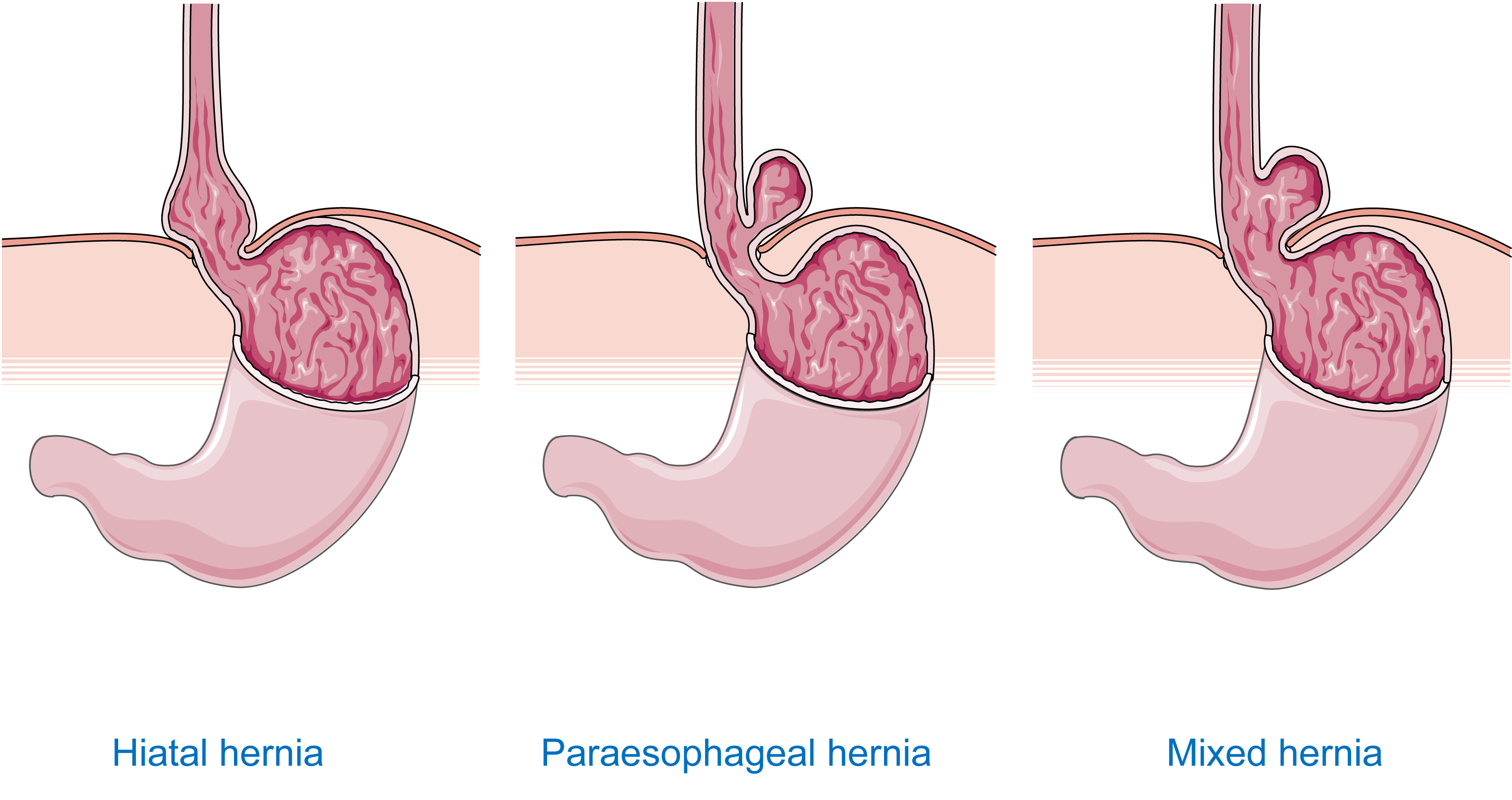 Servier Drawing Hiatal hernia of stomach no labels AnatomyTOOL